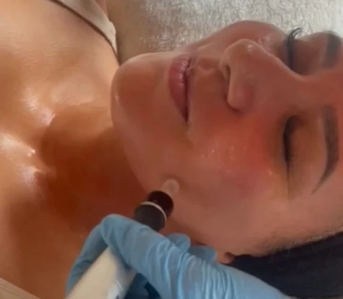 microneedling au boudoir soins